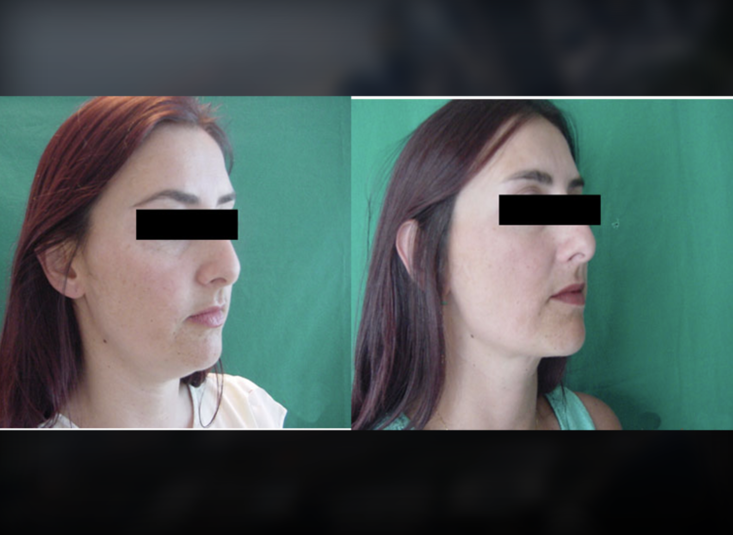 Neck Lift before and after