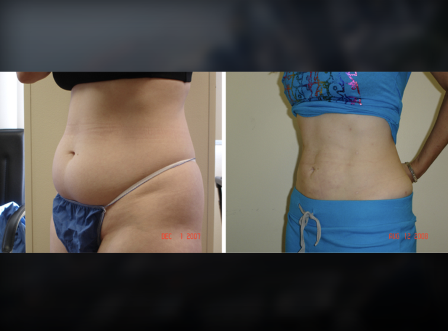 Blepharoplasty before and after