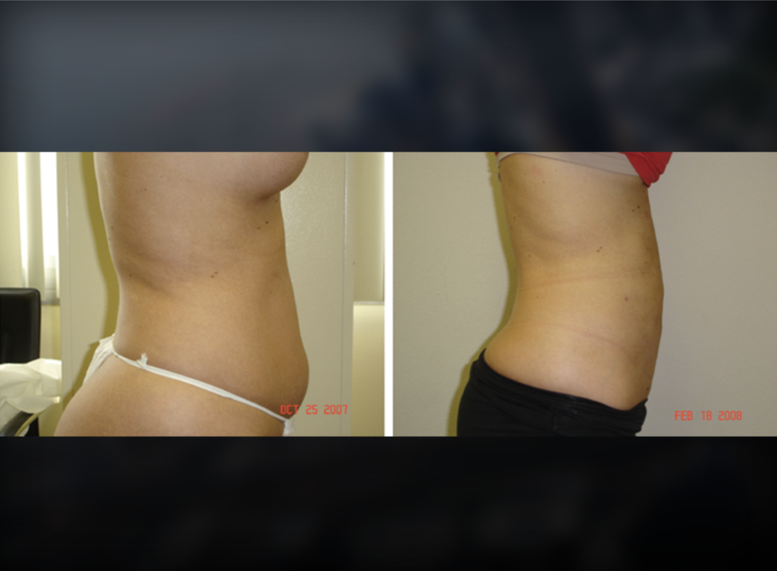 Facelift before and after